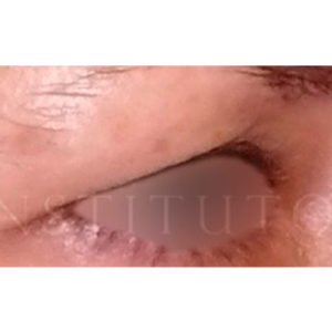 Blefaroplastia láser en Madrid, fotos del antes y después