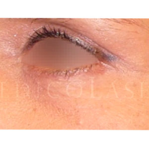 Fotos antes y después de una Blefaroplastia láser en IML