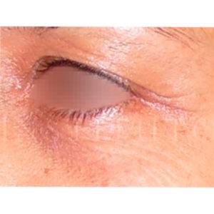 Fotos antes y después de una Blefaroplastia láser en IML