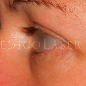 Blefaroplastia superior con Láser de CO2 (Antes y después)