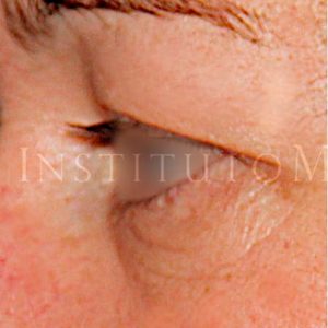 Blefaroplastia superior con Láser de CO2 (Antes y después)