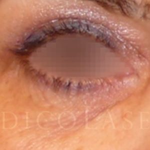 Blefaroplastia y Cantopexia
