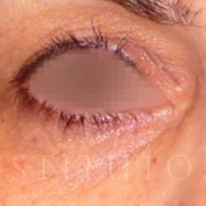 Blefaroplastia y Cantopexia