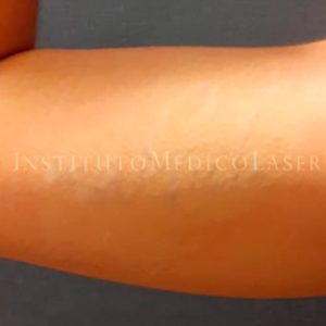 Anyes y después del borrado de tatuajes con láser en Madrid