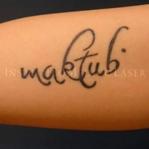 Anyes y después del borrado de tatuajes con láser en Madrid