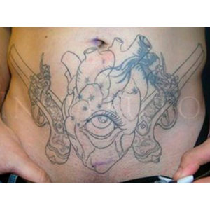 antes y después de borrar un tatuaje