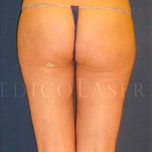 Resultados antes y después de una Lipo IML en cartucheras