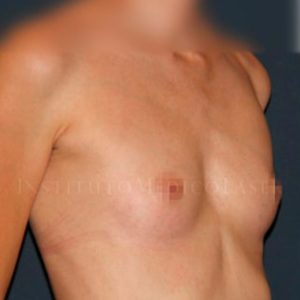 Casos reales antes y después de aumento de pecho en IML