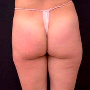 Tratamiento de la celulitis con ondas de choque