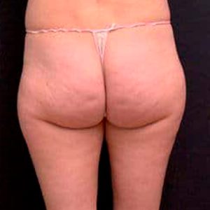 Tratamiento de la celulitis con ondas de choque