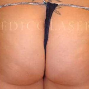 Antes y después de eliminar celulitis en glúteos