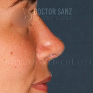 Antes y después de cirugía Estética de la nariz