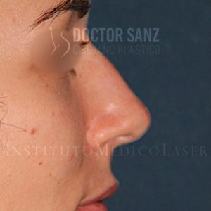 Antes y después de cirugía Estética de la nariz
