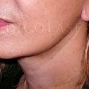 Pre y post cirugía Facial: Lifting