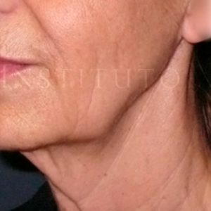 Pre y post cirugía Facial: Lifting