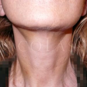 Antes y después de la cirugía lifting para la piel del cuello