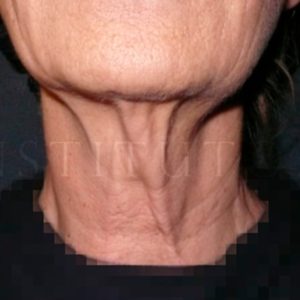 Antes y después de la cirugía lifting para la piel del cuello
