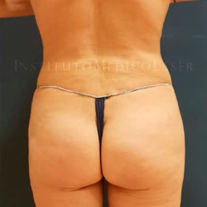 Antes y después de tratamiento contorno corporal completo