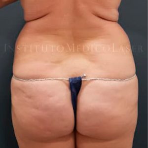 Antes y después de tratamiento contorno corporal completo