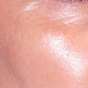 Antes y después de tratar arrugas en el contorno de ojos