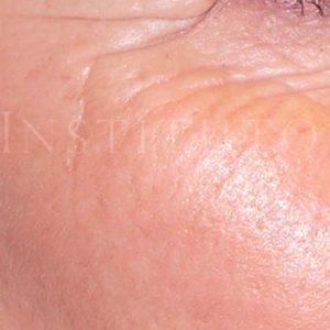 Antes y después de tratar arrugas en el contorno de ojos