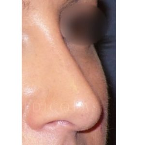 Antes y después de una corrección de hundimiento nasal leve