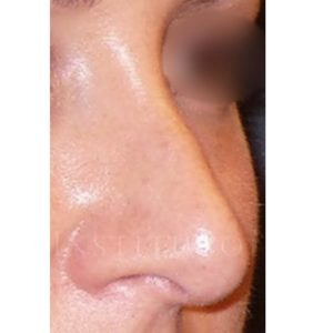 Antes y después de una corrección de hundimiento nasal leve
