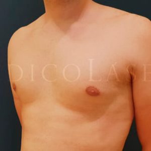 Antes y después de definir pectorales con Lipohelio