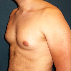Antes y después de definir pectorales con Lipohelio