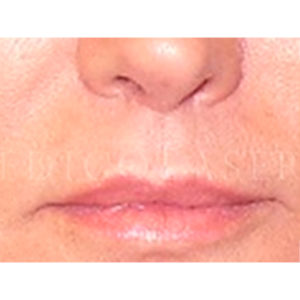 Antes y después de elevar el labio superior