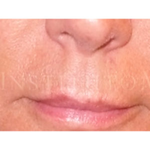 Antes y después de elevar el labio superior