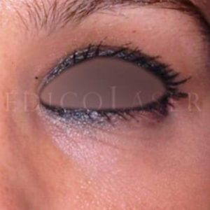 Eliminar bolsas en los ojos