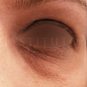 Eliminar bolsas en los ojos