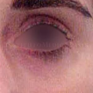 Eliminar bolsas y ojeras antes y después