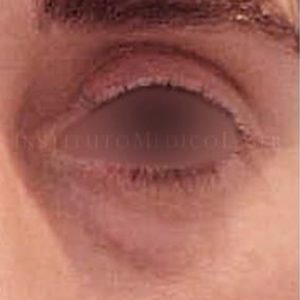 Eliminar bolsas y ojeras antes y después