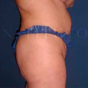 Antes y después de eliminar grasa localizada en el abdomen