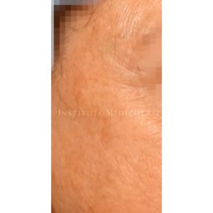 Antes y después de eliminar manchas con Picosure