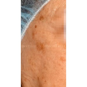Antes y después de eliminar manchas con Picosure