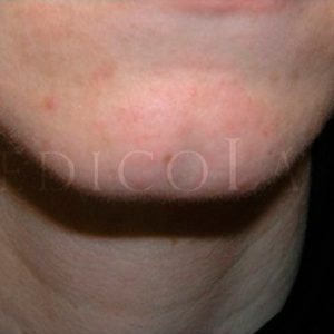 Eliminar nevus con láser, antes y después