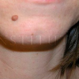 Eliminar nevus con láser, antes y después