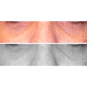 Eliminar ojeras con láser, antes y después