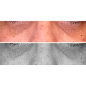 Eliminar ojeras con láser, antes y después