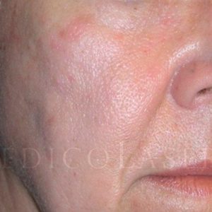 Eliminar queratosis seborreica, antes y después