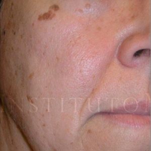Eliminar queratosis seborreica, antes y después