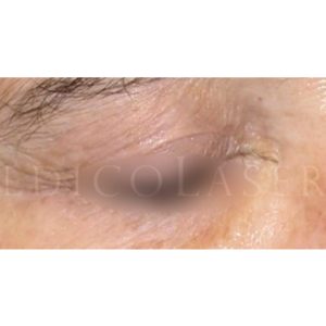 Tratamiento siringomas, antes y después
