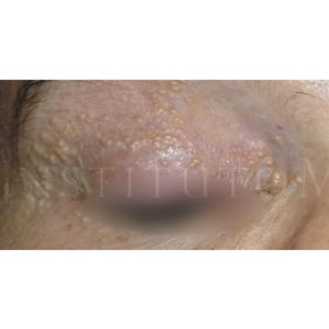 Tratamiento siringomas, antes y después