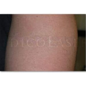 Tatuaje antes y después del tratamiento de eliminación con láser