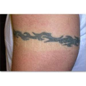 Tatuaje antes y después del tratamiento de eliminación con láser