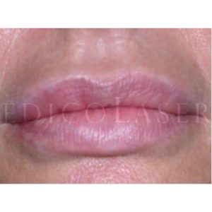 Eliminación de micropigmentación o tatuaje en labios