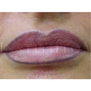 Eliminación de micropigmentación o tatuaje en labios
